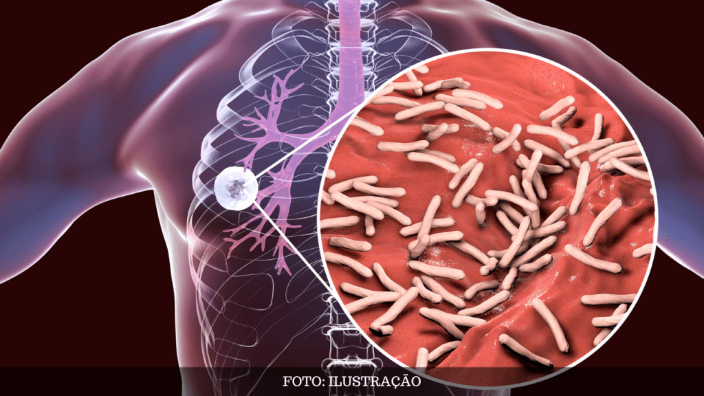 Garça realiza testes de tuberculose em pontos itinerantes na&nbsp;cidade