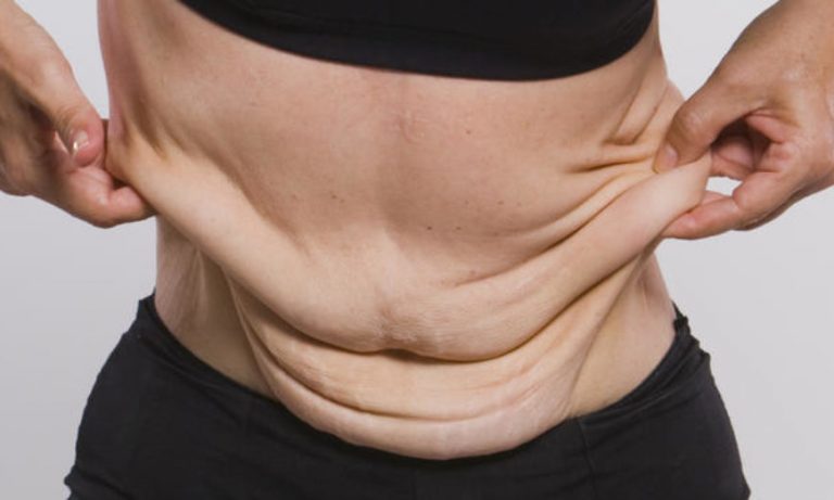 Cirurgia reparadora pós-bariátrica deve ter cobertura obrigatória pelos planos de&nbsp;saúde