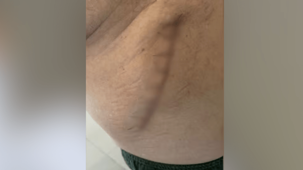 Erro Médico: Idoso tem Vesícula Removida em Cirurgia de Hemorroida em Santa Casa da&nbsp;Região