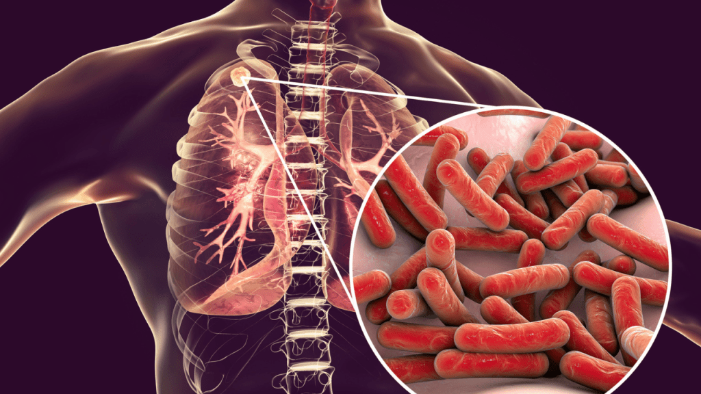4º Óbito por Tuberculose em 2024 é Registrado em&nbsp;Marília