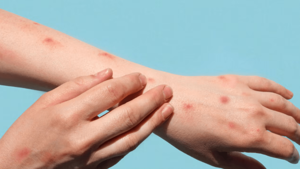 Caso suspeito de Mpox em Marília é descartado&nbsp;oficialmente