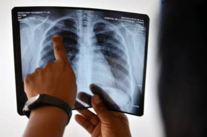 Prevenção: Secretaria da Saúde intensifica ações de conscientização sobre a&nbsp;Tuberculose